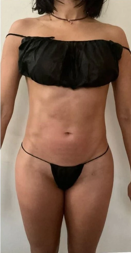 Client 1 after treatment, standing front view of the abdomen and waist