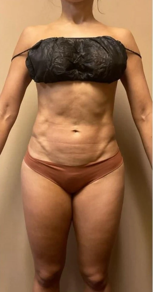 Client 1 before treatment, standing front view of the abdomen and waist