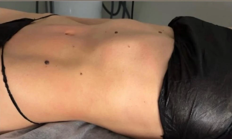 Client 2 before treatment, close-up of the abdomen while lying on the treatment table