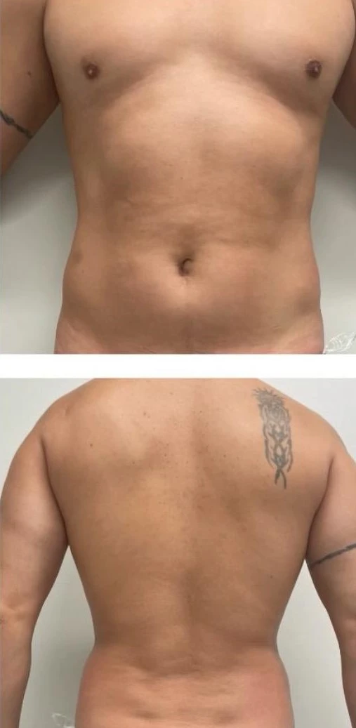 Client 3 after treatment, combined front and back photographs of the torso