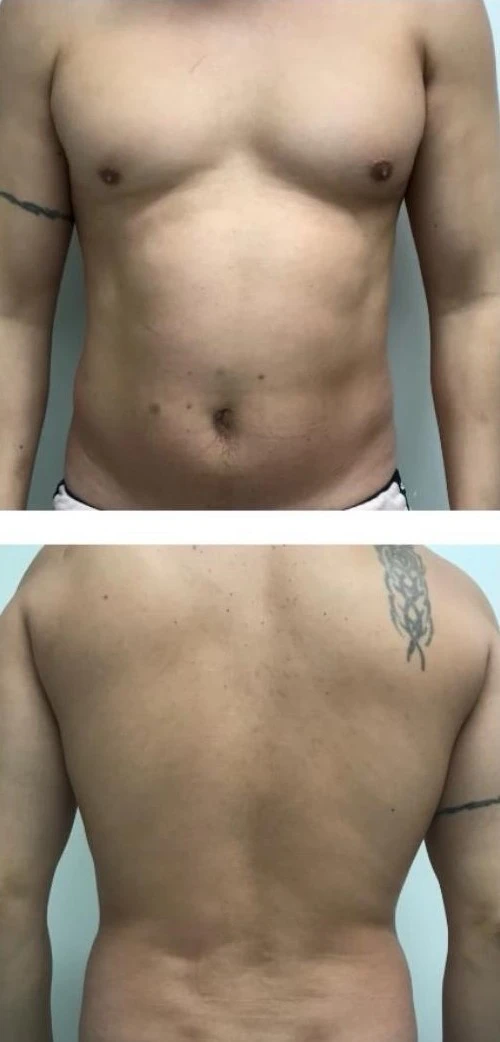 Client 3 before treatment, combined front and back photographs of the torso